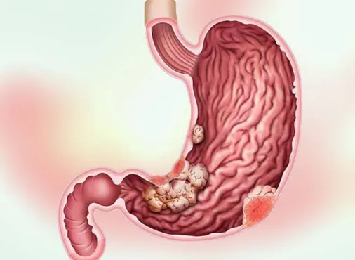 Gastric Tumours consultation at Niraaya Hospital